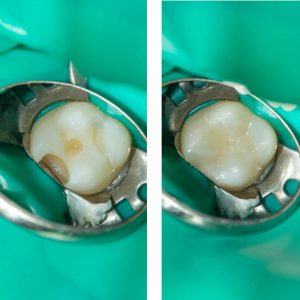 Fillings Before and After