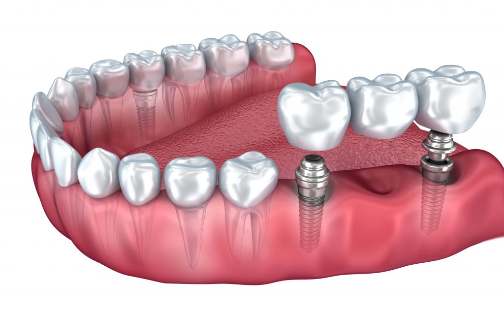 Dental Bridges