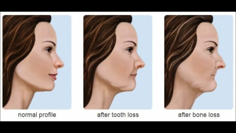 Periodontal Tooth Loss Dental Now Panorama